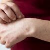 濕疹怎麼辦？濕疹症狀、成因、治療方法一次看清