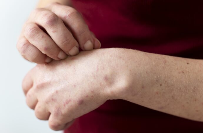 濕疹怎麼辦？濕疹症狀、成因、治療方法一次看清