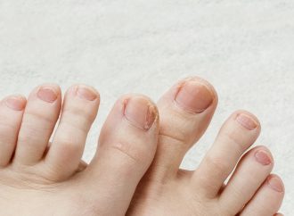 認識甲癬(灰甲)——預防與治療的專業指引