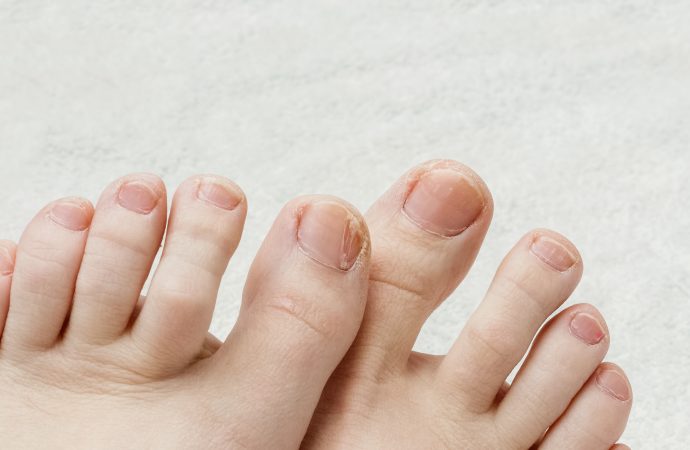 認識甲癬（灰甲）——預防與治療的專業指引