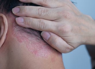 脂溢性皮膚炎:常見、卻容易被誤解的皮膚問題