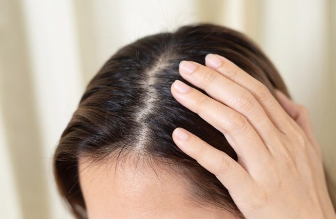 點樣分辨女性型脫髮?成因與求醫提示