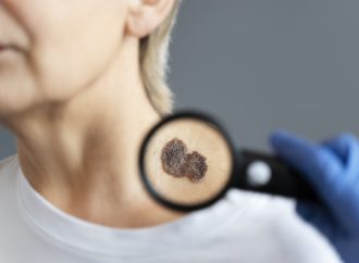 脂溢性角化:常見但不容忽視的皮膚「老化印記」