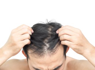 男士甩頭髮原因有哪些？拆解男士脫髮先兆、常見成因與求醫時機