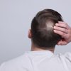 男士掉髮如何改善?3步找出合適的脫髮解決方法