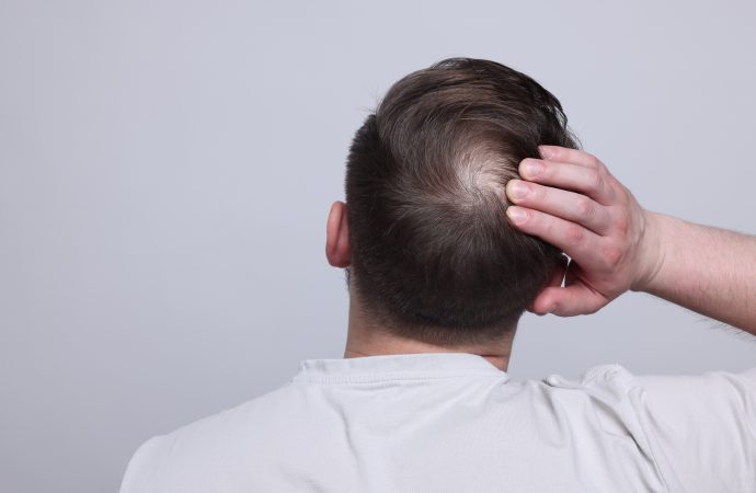 男士掉髮如何改善?3步找出合適的脫髮解決方法