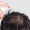 韓國防脫髮產品怎樣選?比較洗頭水、頭皮精華及防脫髮藥