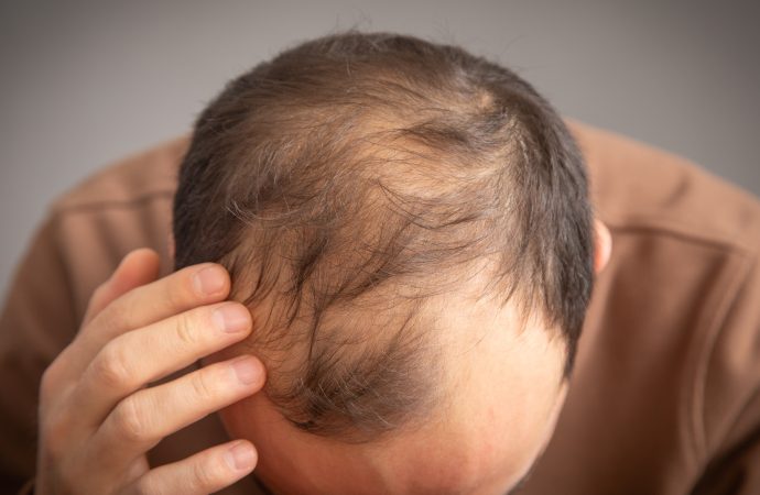 更年期脫髮問題怎樣改善?拆解成因、掉髮特徵與脫髮解決方法